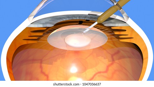 Phacoemulsification Surgery For Cataract, 3d Render, 4K Video Available, Clip Id 1006594357