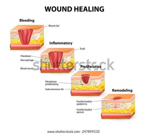 創傷治癒プロセスの段階 止血 炎症 増殖 成熟 リモデリングの段階 のイラスト素材