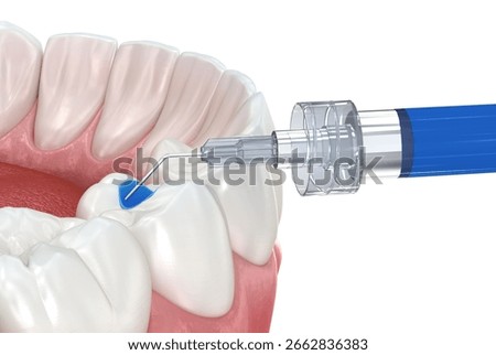 Phosphoric acidselective enamel etching of the tooth. Medically accurate tooth 3D illustration