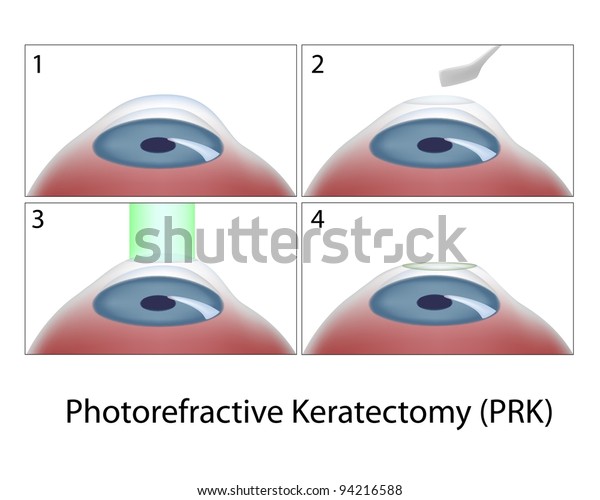 Photorefractive Keratectomy Prk Surgery Stock Illustration 94216588