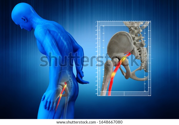 Pinched Human Sciatic Nerve Anatomical Vision Stock Illustration 1648667080