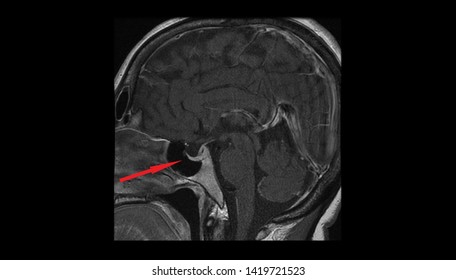 Pituitary Gland, Hypophysis MRI Scan (Magnetic Resonance Imaging), Detailed Anatomy Of Human Brain