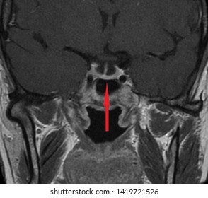 Pituitary Gland, Hypophysis MRI Scan (Magnetic Resonance Imaging), Detailed Anatomy Of Human Brain