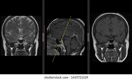 Pituitary Gland, Hypophysis MRI Scan (Magnetic Resonance Imaging), Detailed Anatomy Of Human Brain