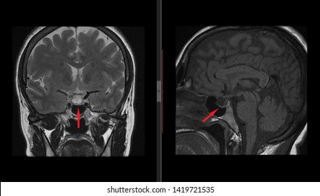 Pituitary Gland, Hypophysis MRI Scan (Magnetic Resonance Imaging), Detailed Anatomy Of Human Brain