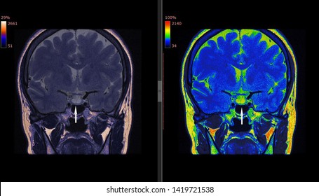 Pituitary Gland, Hypophysis MRI Scan (Magnetic Resonance Imaging), Detailed Anatomy Of Human Brain