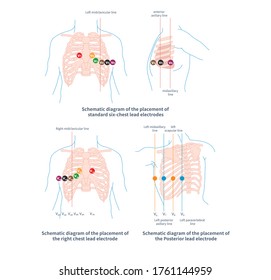 placement of chest lead electrodes