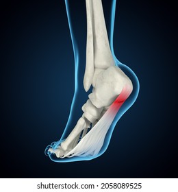 Plantar Fasciitis 3D Rendering, Foot Anatomy, Heel Pain