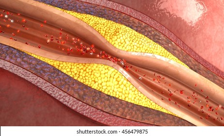 Plaque In Blood Vessels 3d Illustration