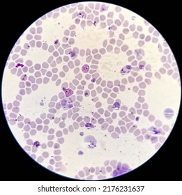 Plasmodium Vivax Tropozoit In Thin Blood Smear. 