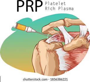 Platelet Rich Plasma (PRP) treatment for rotator cuff injury