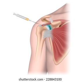 Platelet Rich Plasma (prp) Treatment For Rotator Cuff Injury