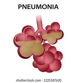 Pneumonia Alveoli Icon. Realistic Illustration Of Pneumonia Alveoli Icon For Web Design Isolated On White Background