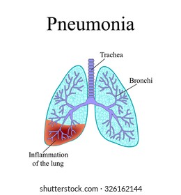 Pneumonia Anatomical Structure Human Lung Illustration Stock ...