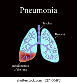 Pneumonia Anatomical Structure Human Lung Type 스톡 벡터(로열티 프리) 374187139 ...