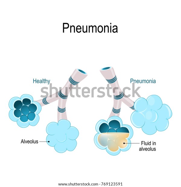 Pneumonia Healthy Alveoli Alveolus Pneumonia Illustration Stock ...