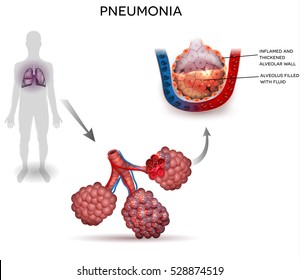 Pneumonia Illustration Human Silhouette Lungs Close Stock Illustration ...