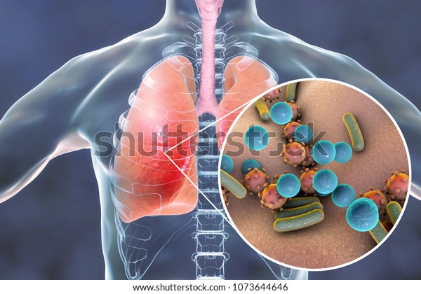 giant microbes pneumonia