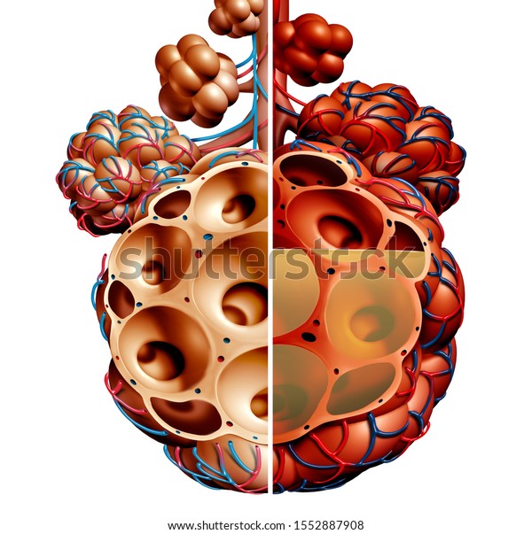 Pneumonia\
and Pulmonary alveoli with fluid diagram or alveolus inflammation\
anatomy diagram as a medical concept of healthy and unhealthy lung\
anatomy as a 3D illustration isolated on\
white.