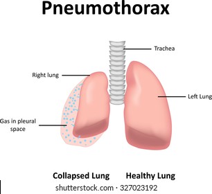 Pneumothorax