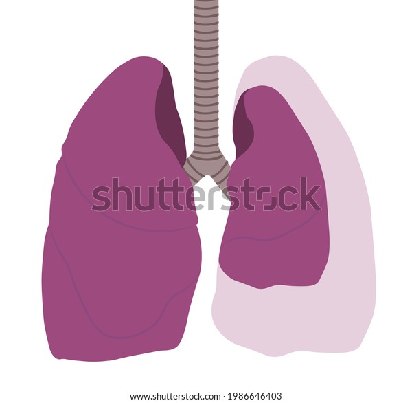 Pneumothorax Illustration Normal Lung Versus Collapsed Stock Illustration 1986646403 Shutterstock 8627