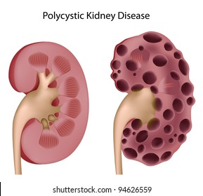 Polycystic Kidney Disease