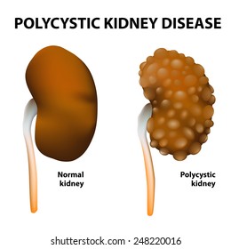 Polycystic Kidney Disease. Normal And Polycystic Kidneys