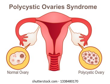 Polycystic Ovaries Syndrome