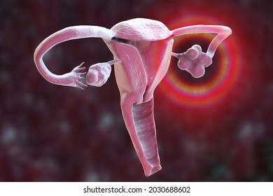 Polycystic ovary syndrome, 3D illustration showing healthy ovary (right) and enlarged ovary with cysts (left)