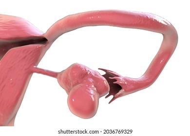 Polycystic ovary syndrome, 3D illustration showing enlarged left ovary with cysts