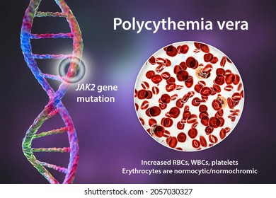 Polycythemia Vera, A Rare Slow-growing Blood Cancer With An Increase In The Number Of Red Blood Cells In The Body Due To Mutation In The JAK2 Gene, 3D Illustration Showing Abundant Erythrocytes Inside