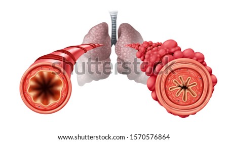 Popcorn lung condition concept or obliterative bronchiolitis disease as obstructed bronchial tubes constricted caused by vaping with 3D illustration elements.