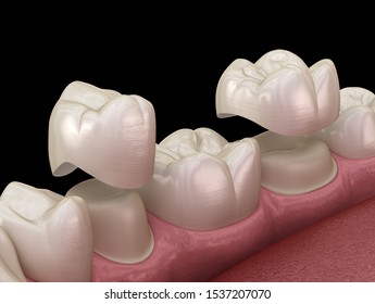 Porcelain Crowns Placement Over Premolar And Molar Teeth. . Medically Accurate 3D Illustration