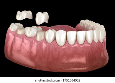 Porcelain Crowns Placement Over Premolar And Molar Teeth. . Medically Accurate 3D Illustration