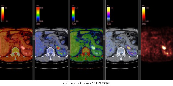 Positron Emission Tomography Or PET CT Scan Of Human Body (High Resolution)