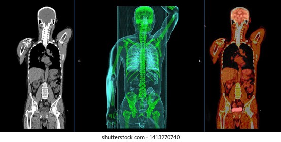 Positron Emission Tomography Or PET CT Scan Of Human Body (High Resolution)