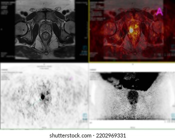 Positron Emission Tomography (PET) CT Scan Uses A Radioactive Drug (tracer) To Show Both Normal And Abnormal Metabolic Activity Of Whole  Human Body  For Detect Cancer Recurrence After Surgery .