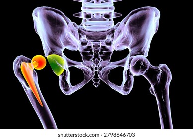 Posterior dislocation of total hip replacement, 3D illustration showing posterior displacement of the prosthetic femoral head from the acetabular component, isolated medical depiction.