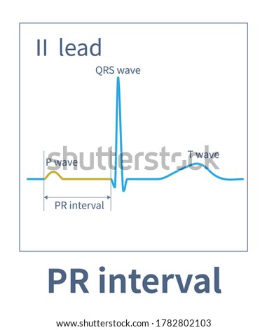 The PR interval of ECG refers to the time from the starting point of P wave to the starting point of QRS wave, which is the time when the electrical impulse conducts in the conduction system.