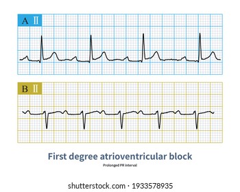 PR interval was prolonged and QRS wave was not dropped when atrioventricular block was once performed.