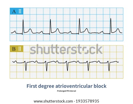PR interval was prolonged and QRS wave was not dropped when atrioventricular block was once performed. [[stock_photo]] © 