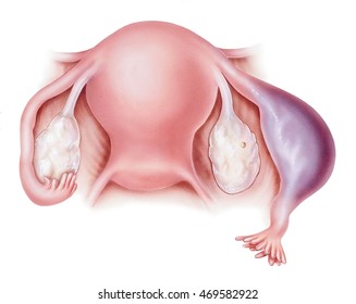 Pregnancy - Ectopic. Ectopic Pregnancy Occurs When A Fertilized Egg Attaches And Begins To Develop Outside The Uterus. Ectopic Pregnancies Occur In The Fallopian Tube, Ovary, Or Cervix.
