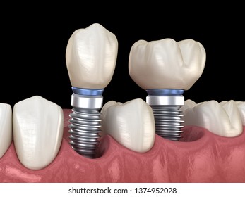 Premolar Molar Tooth Crown Installation Over Stock Illustration ...