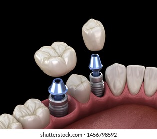 Premolar Molar Tooth Crown Installation Over Stock Illustration ...