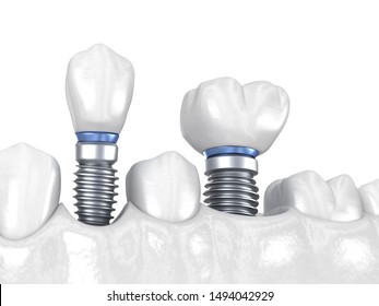 Premolar Tooth Crown Installation Over Implant Stock Illustration ...