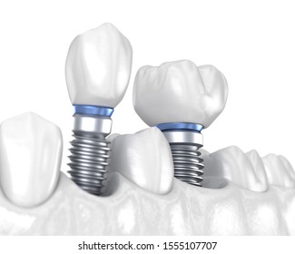 Premolar Molar Tooth Crown Installation Over Stock Illustration 1555107707