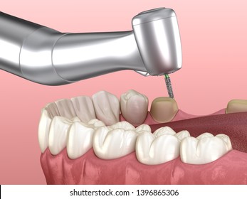 Dental Veneers Porcelain Veneer Installation Procedure Stock ...