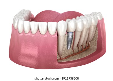 Premolar tooth crown installation over implant abutment. Medically accurate 3D illustration of human teeth and dentures concept - Powered by Shutterstock