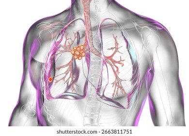 Primary lung tuberculosis with the Ranke complex. 3D illustration highlighting pulmonary lesions and mediastinal lymphadenitis.