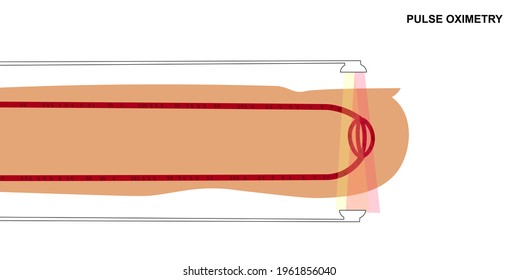 Principle Of Reading Pulse Oximeter. Emission Of Light Through Blood Capillaries